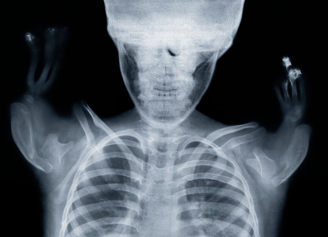 Thalidomide child,X-ray