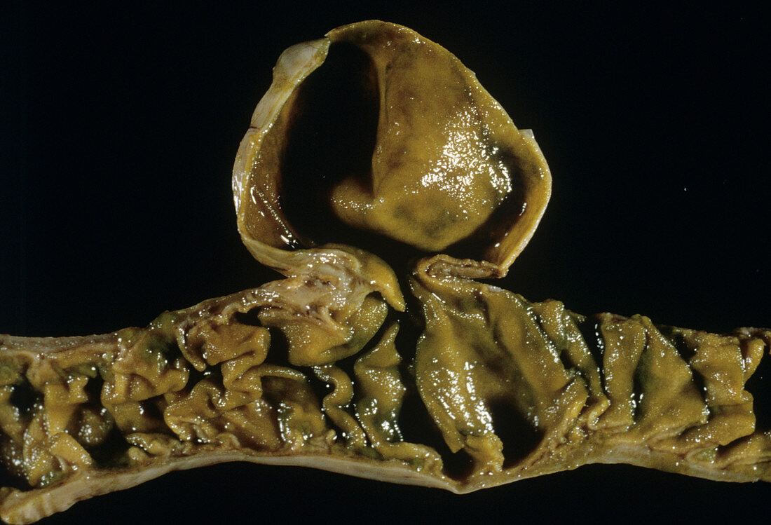 Meckel's diverticulum of the intestine