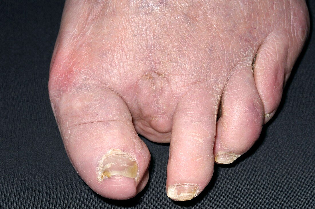 Amputation for ulcerated hammer toe
