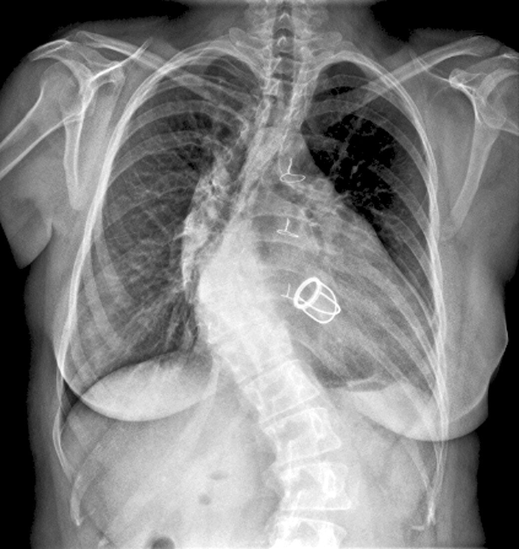 Kyphoscoliosis,X-ray