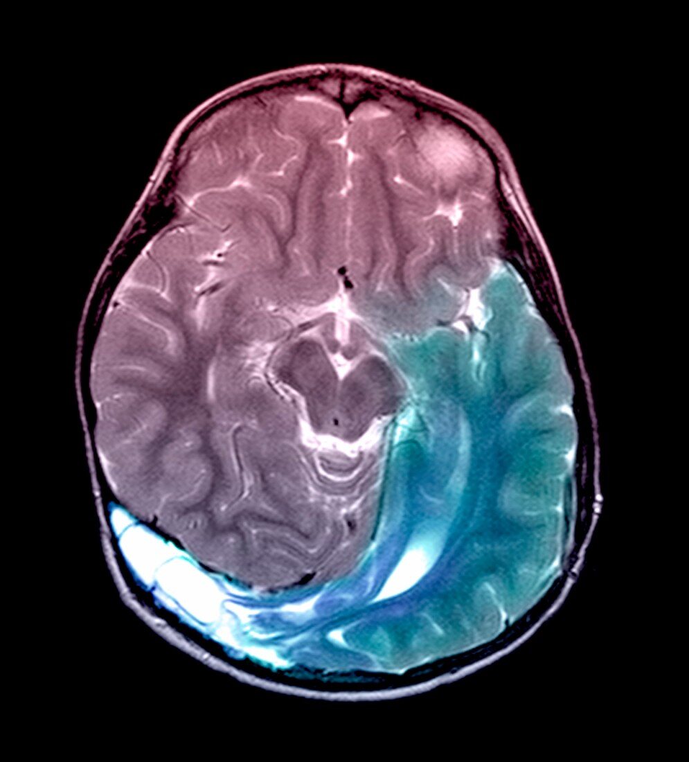 Deformed head,MRI scan