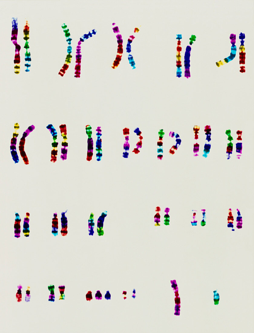 Col karyotype of chromosomes in Down's syndrome