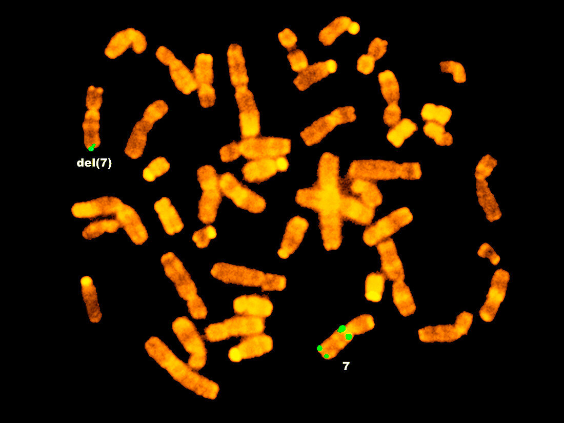 FISH micrograph of Williams syndrome chromosomes