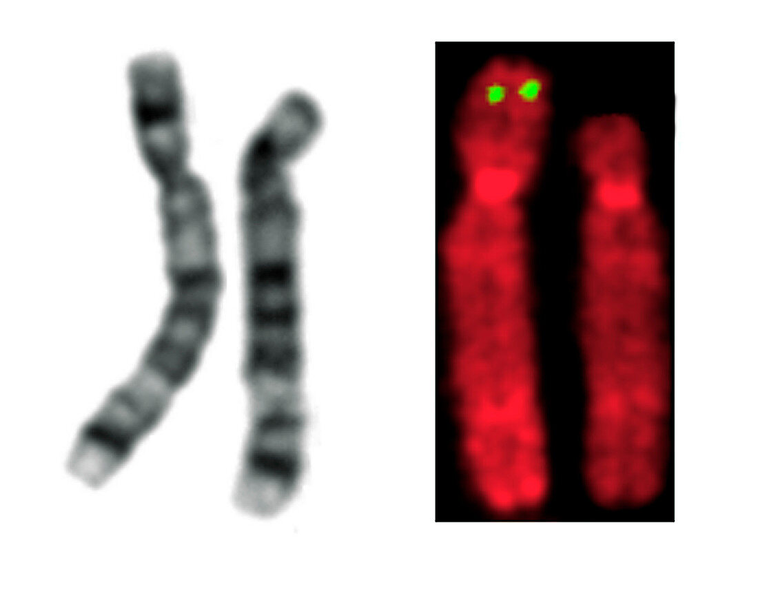 FISH micrograph showing cri du chat chromosomes