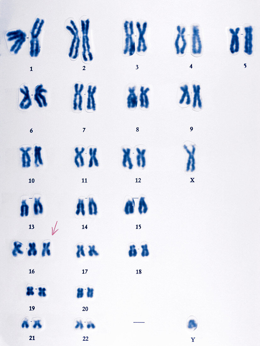 Trisomy 16 chromosomes
