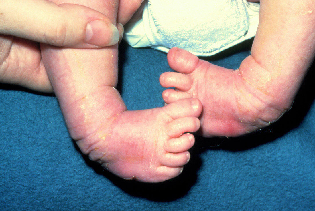 Newborn baby with club foot