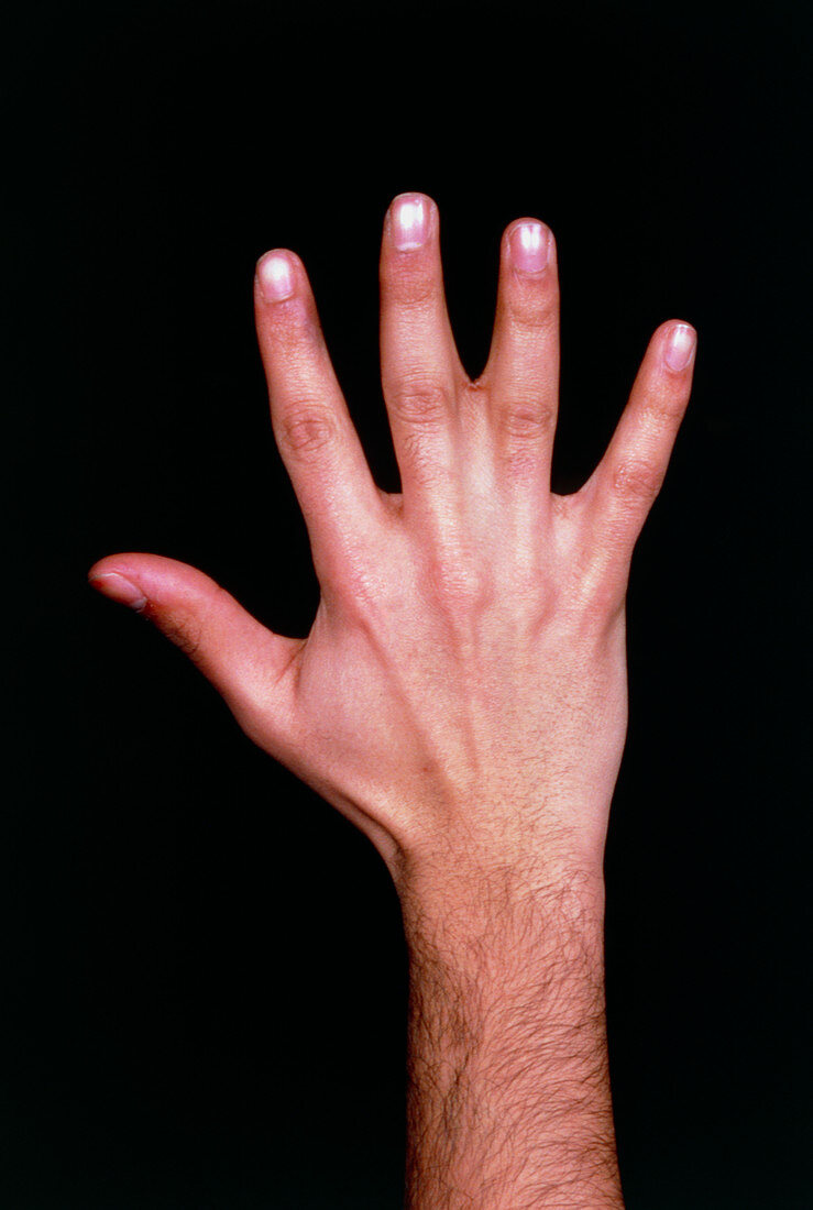 Photo showing congenital fusion of 2 fingers