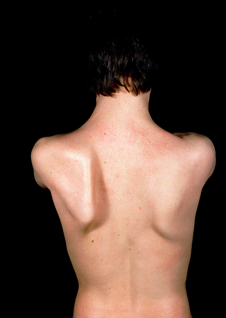 Patient with winged scapula