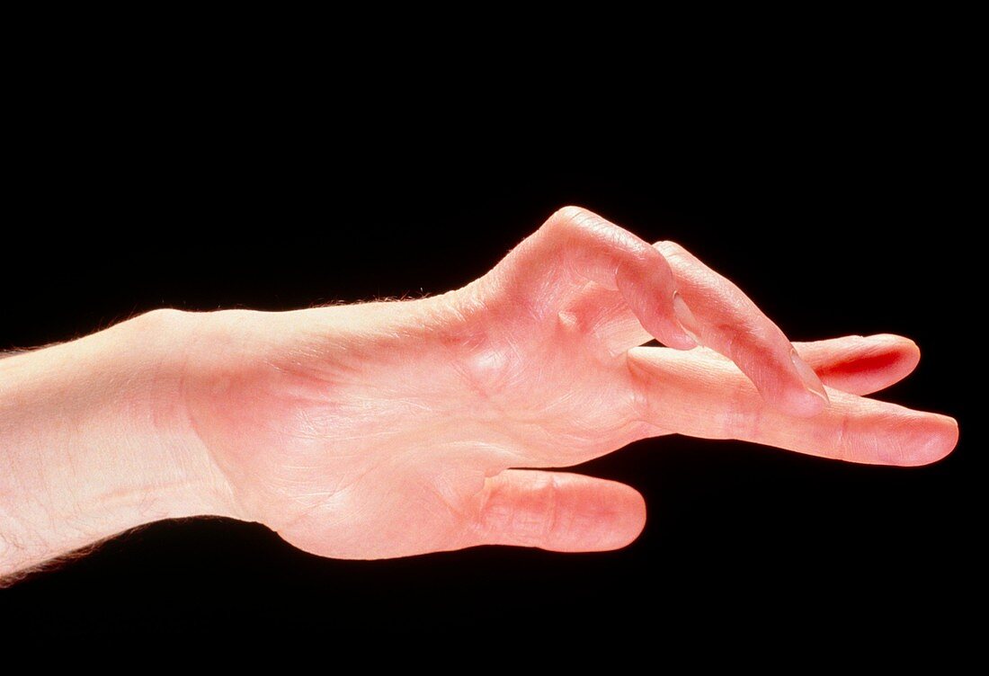 Claw-hand due to trapped ulnar nerve