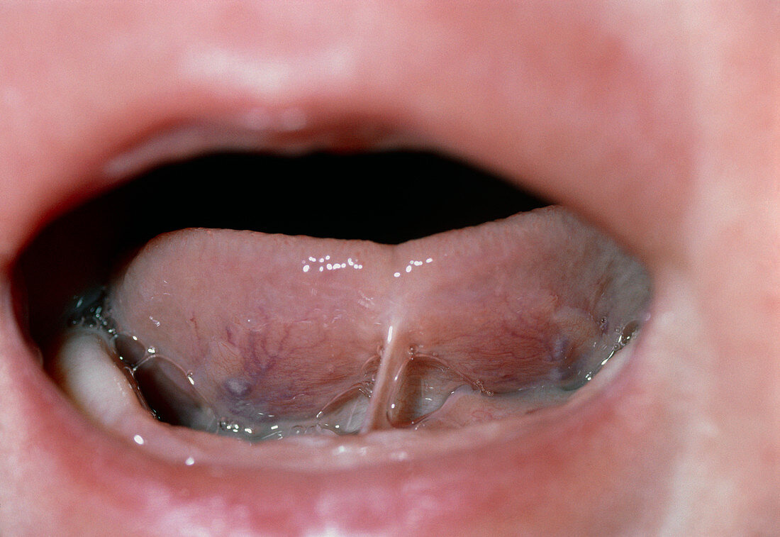 Tongue-tie: a congenital deformity in 1 month old