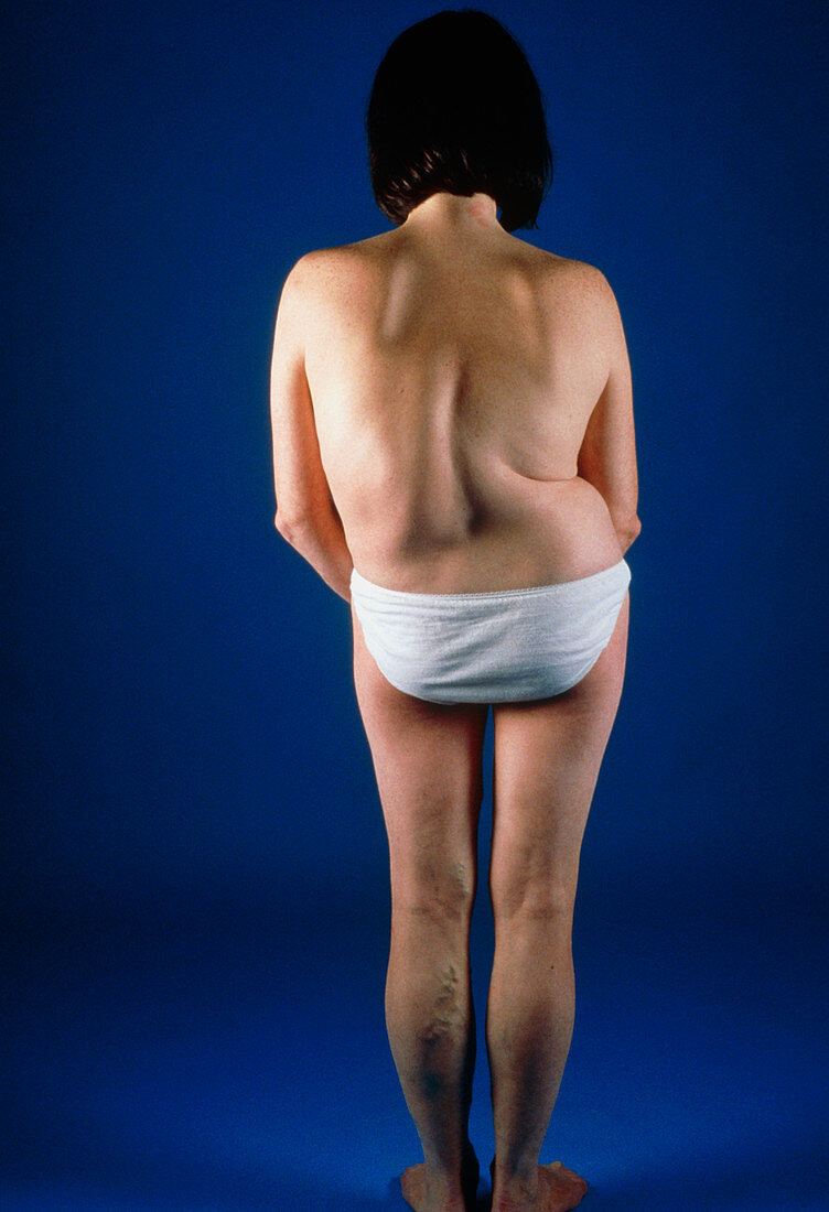 Woman with scoliosis (curvature) of the spine