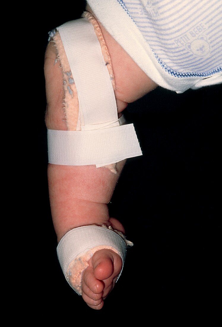 Baby's club foot (talipes equinovarus) in splint