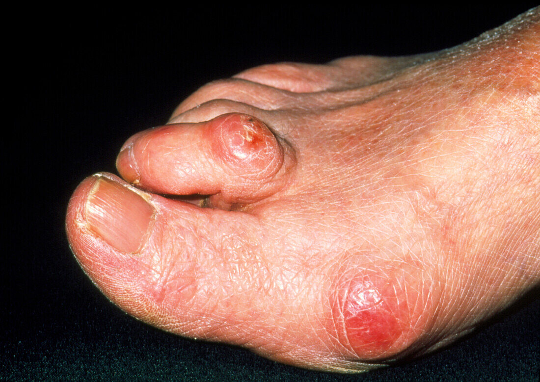 Hammer toe and bunions on elderly woman's foot