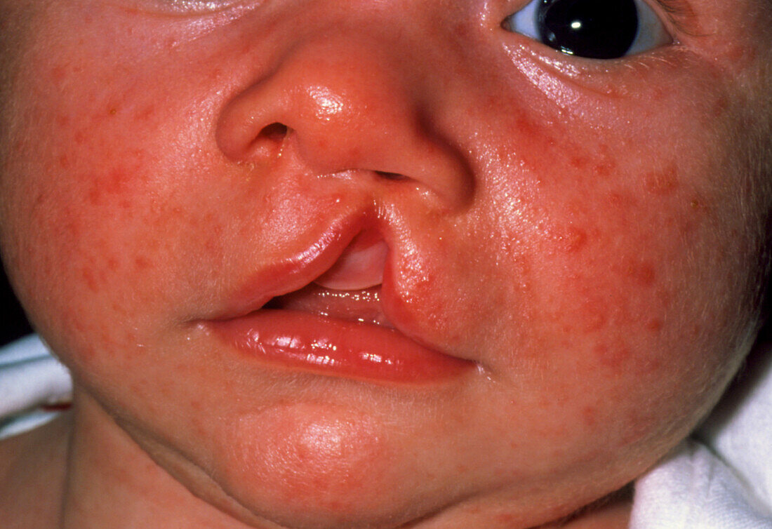 Baby's face showing cleft lip