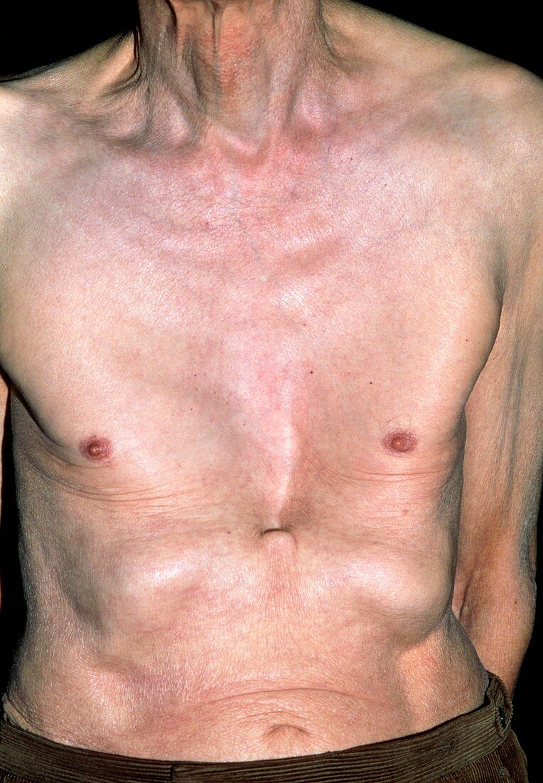 Funnel chest,Pectus excavatum,in an … Bild kaufen 11845907 Science