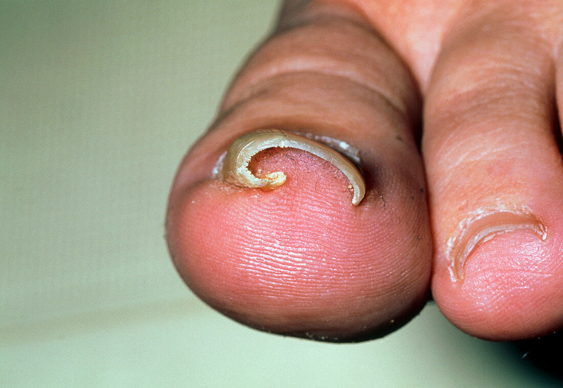 Close-up of an ingrowing toenail