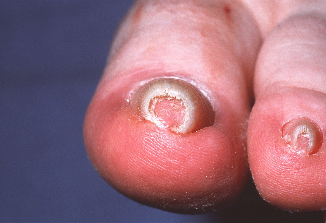 Involuted toenail