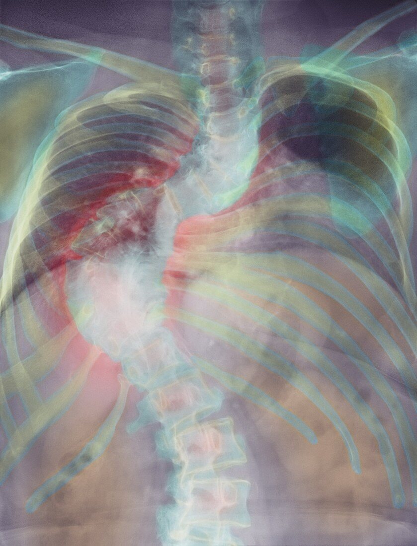 Deformed spine in scoliosis,coloured X-ray