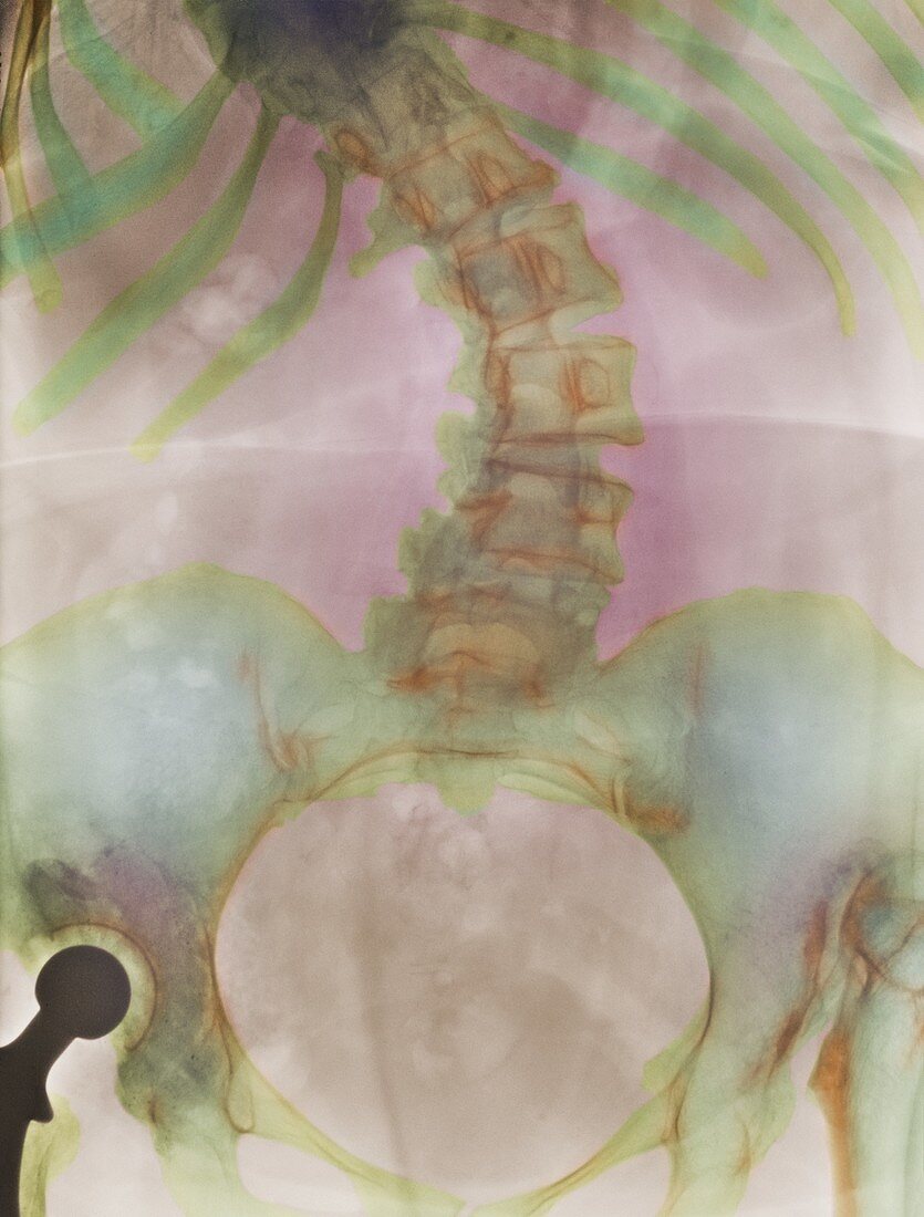 Scoliosis spine deformity,X-ray