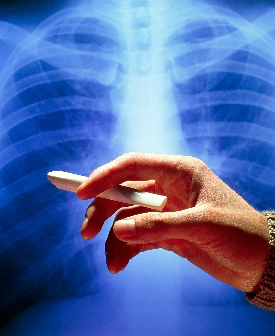 Hand holds Nicorette inhaler beside chest X-ray