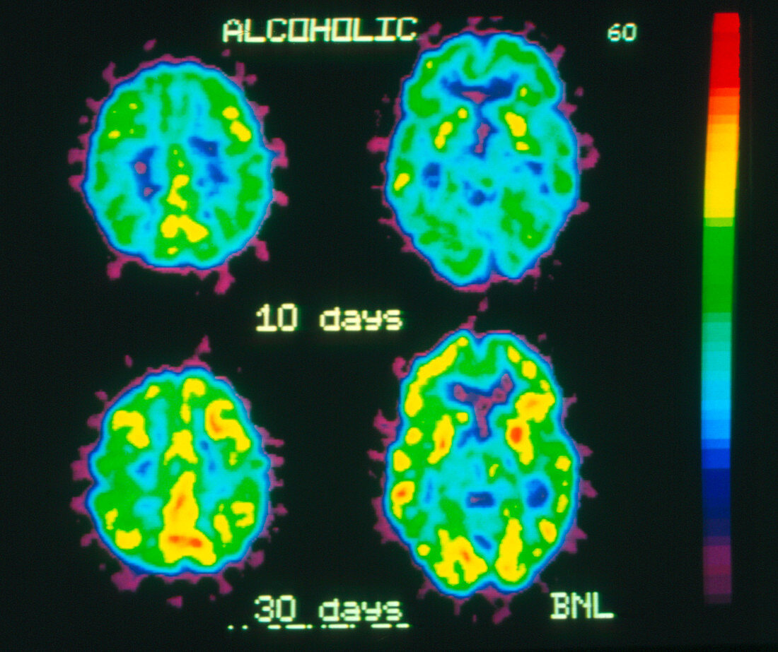 Coloured PET brain scans of alcohol withdrawal