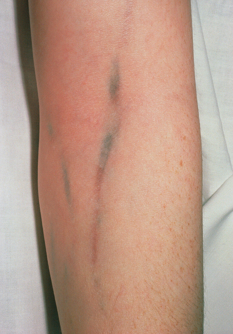 Injection tracking marks on arm of heroin addict