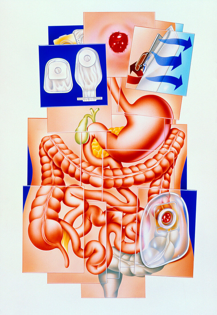 Artwork of human intestines and colostomy