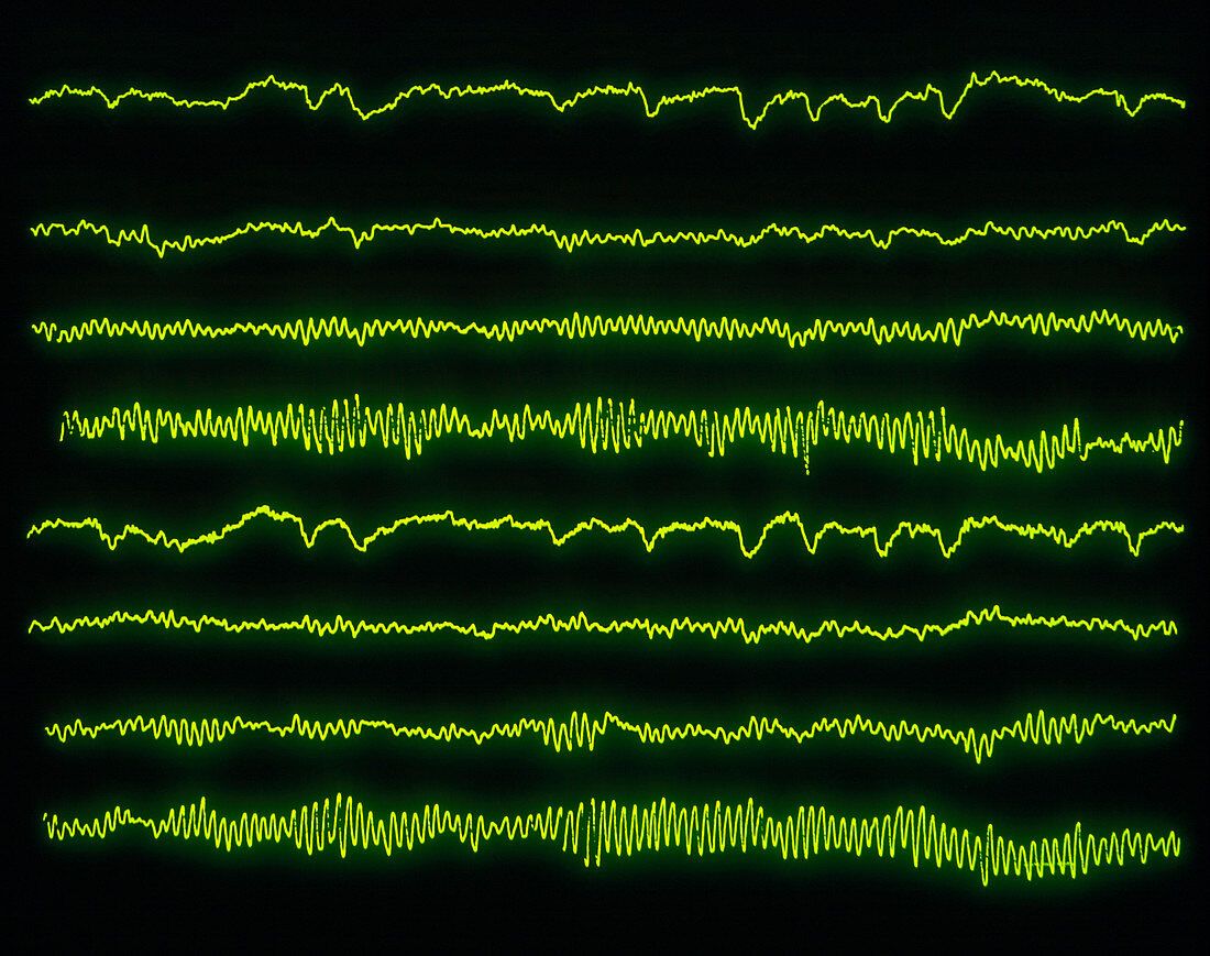 Normal EEG pattern (8 channels)