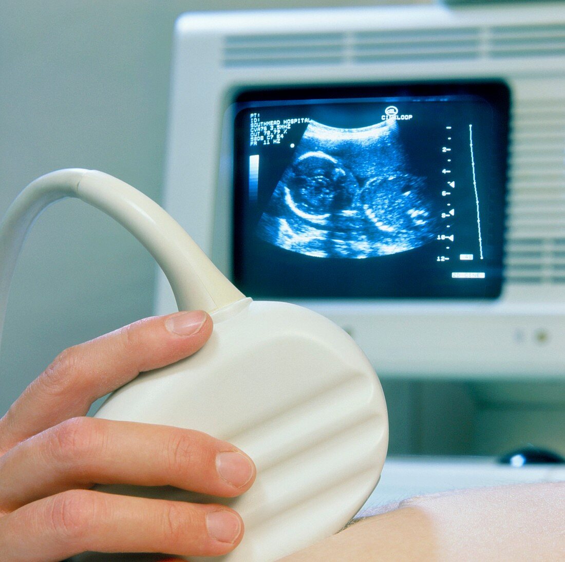 Ultrasound scanning of a pregnant woman