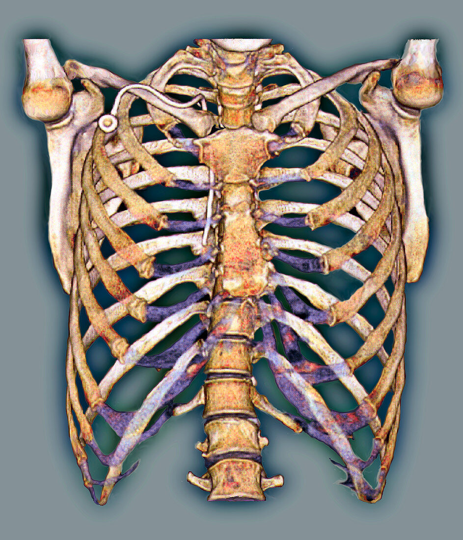 Permanent chest catheter,3D CT scan