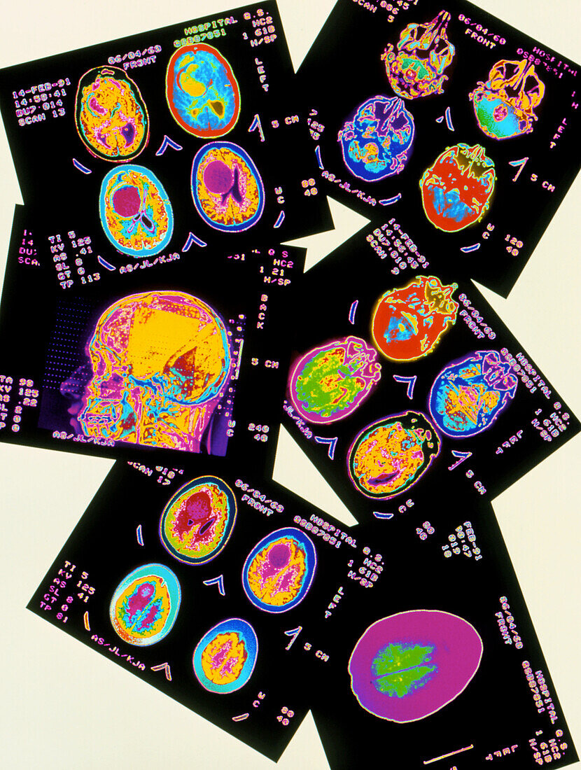 Coloured CT scans of the brain on a light box