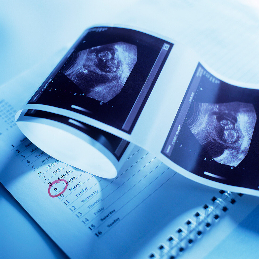 Foetus ultrasound