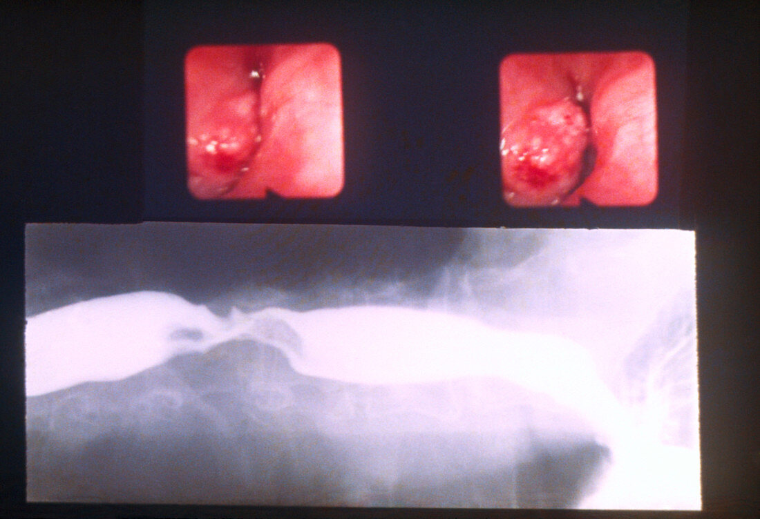 Carcinoma in the oesophagus