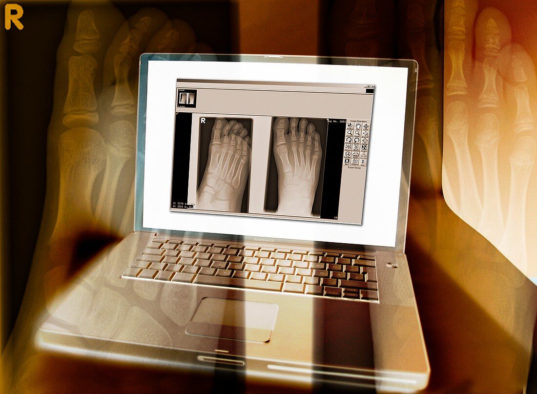 Foot X-rays on a laptop computer,artwork
