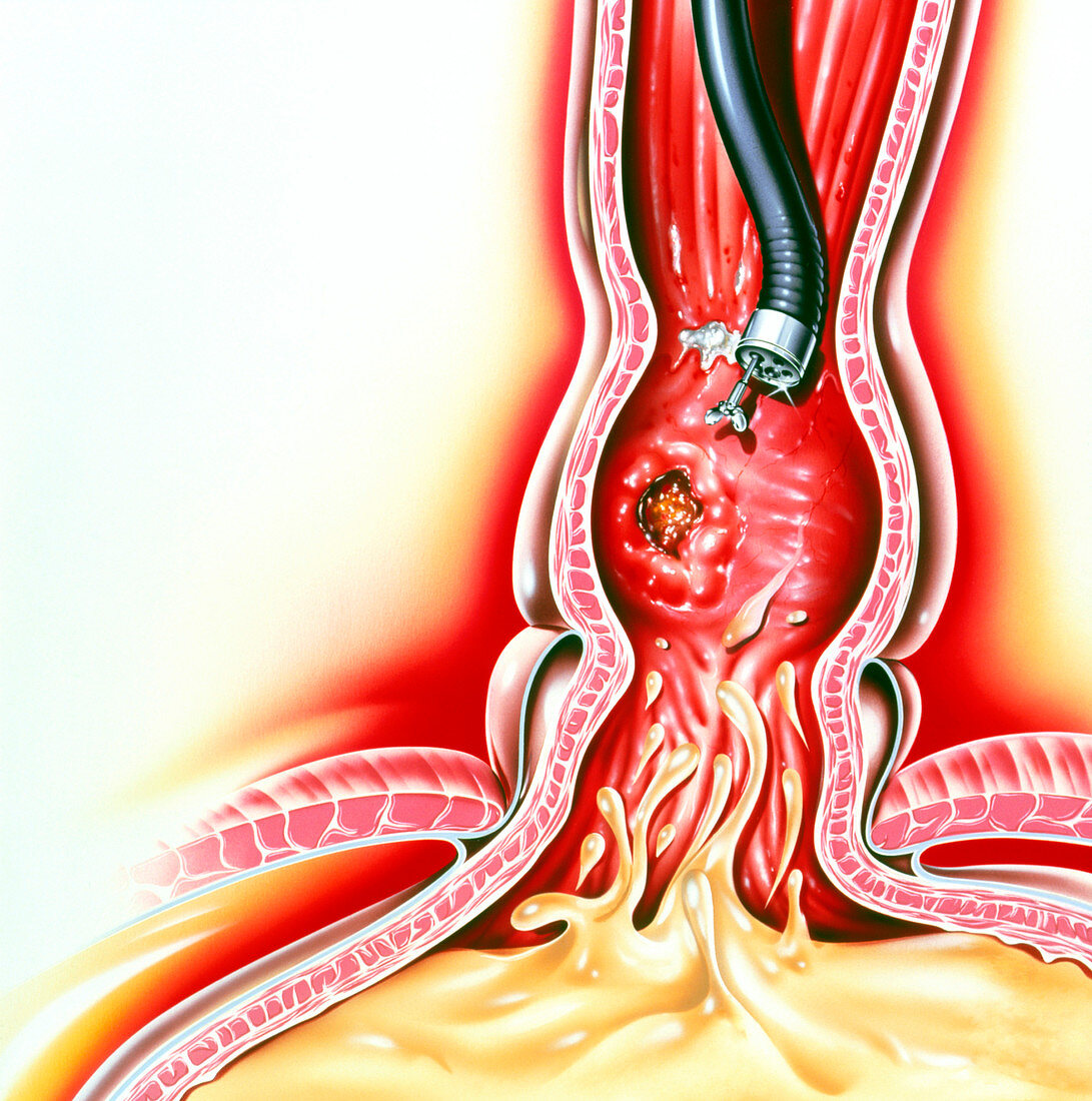 Endoscopic biopsy