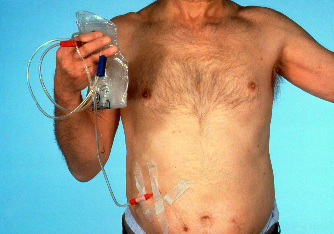 Man undergoing ambulatory peritonal dialysis