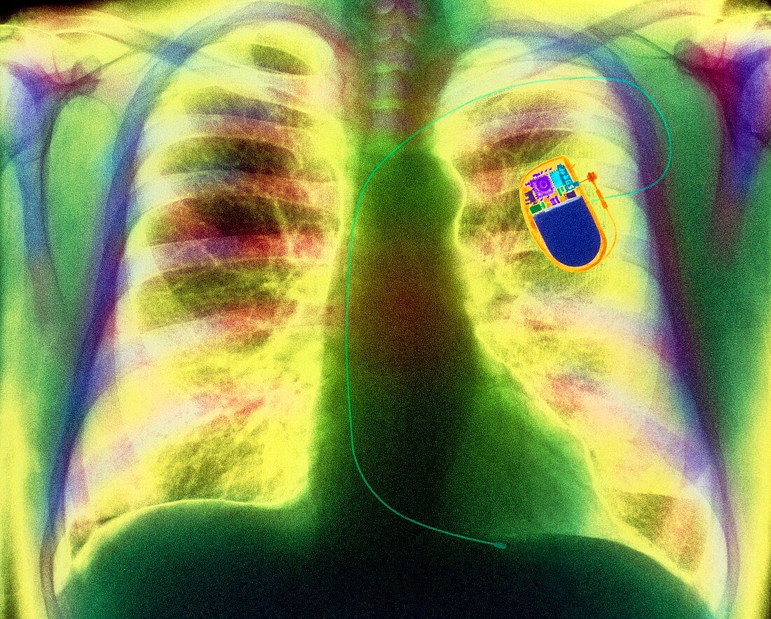 Coloured X-ray of chest showing heart pacemaker