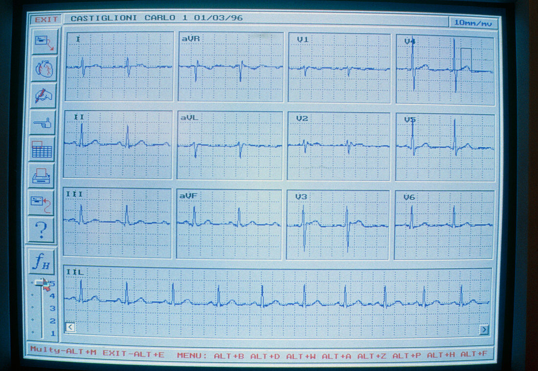 Electrocardiographs received by telephone