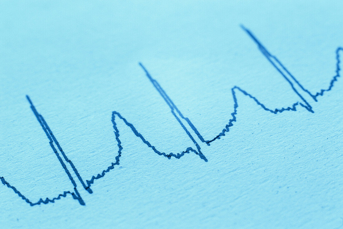 ECG of a normal heart rate