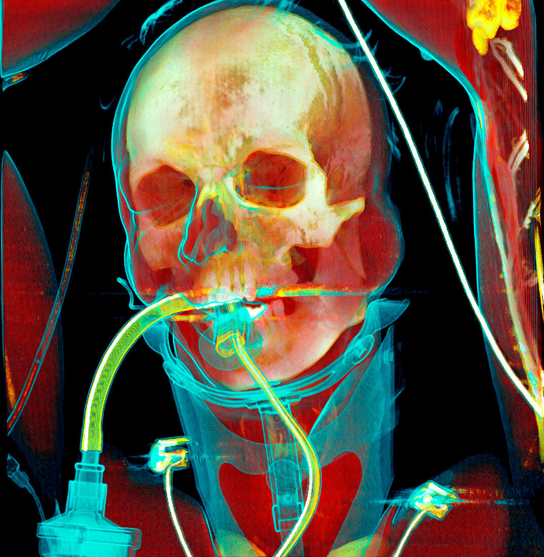 Intensive care patient,CT scan