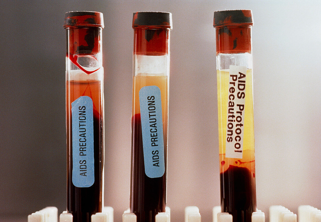 Human blood sample tubes marked for AIDS