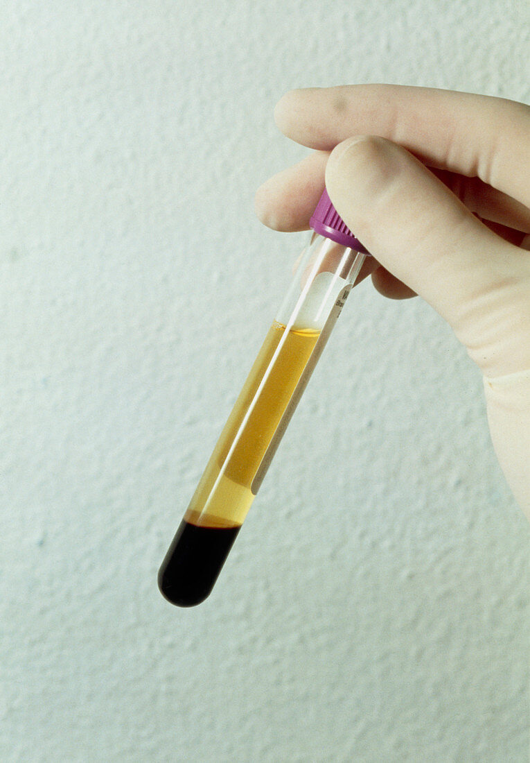A centrifuged blood sample in a test tube