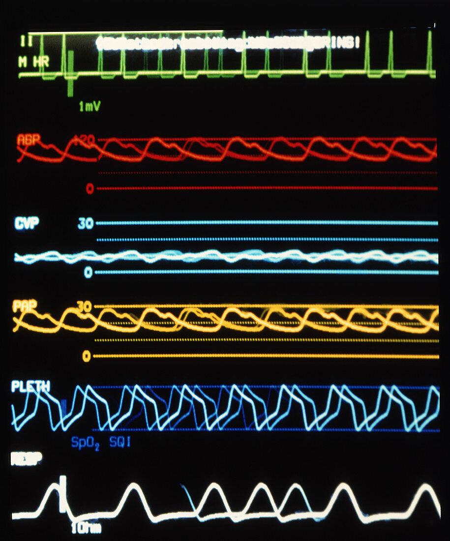 Intensive care monitor with patient's vital signs