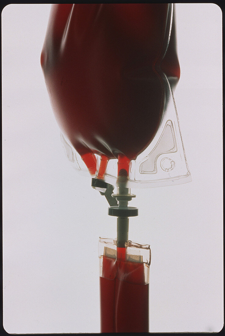 Bag of blood used for transfusion with an IV drip