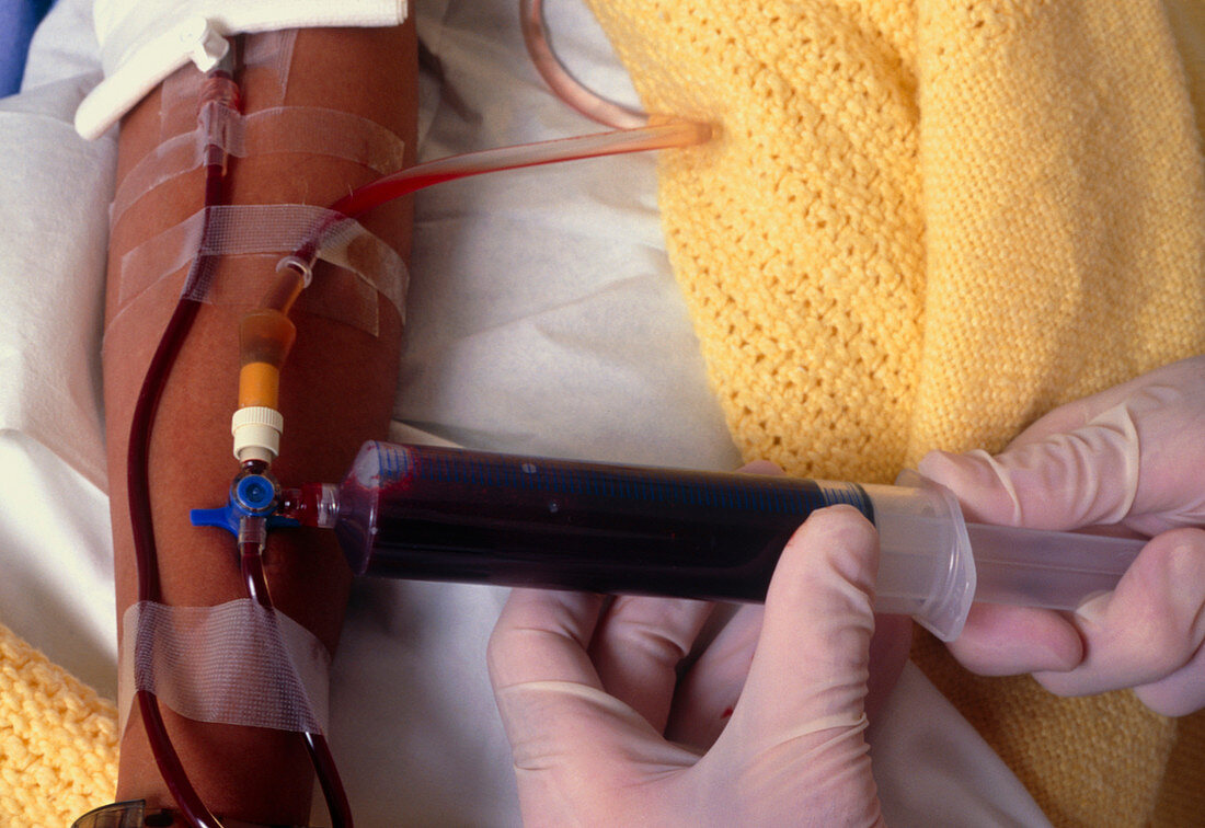 Sickle cell patient has blood transfusion in arm