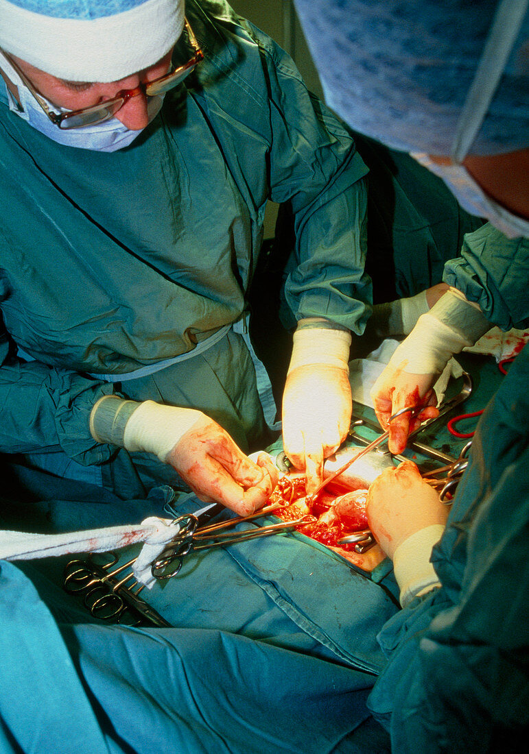 Surgeons performing a hysterectomy operation