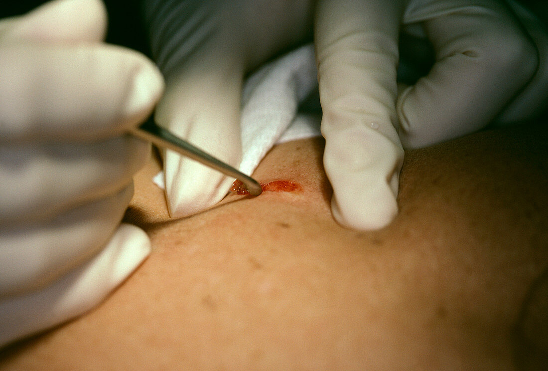 Mole removal