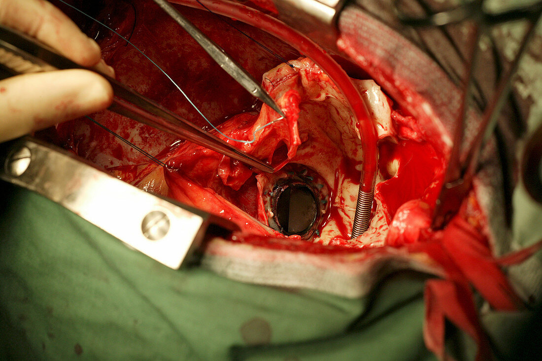 Aorta surgery