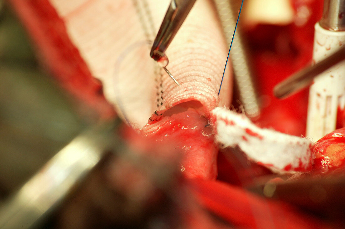 Aorta surgery