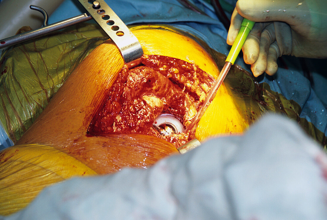 Hip replacement surgery